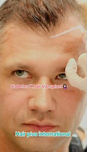 Mall of kpk University Road Peshawar #foryou #transformationjourney #fuetransplant #hairplus #hairrestoration #trending | Hair Plus International Hair Transplant Center | Facebook