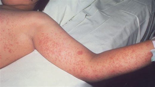 Vitamin A toxicity cases reported in Texas measles patients