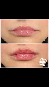 5 comments | We love finishing off facial balancing with lips! #privemedspa #lipfiller #juvederm #juvedermlips #lexingtonky | Privé Med Spa | Facebook