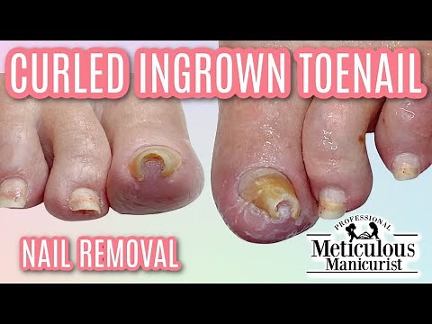 CURLED INGROWN TOENAIL REMOVAL