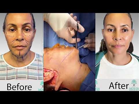 Facelift (rhytidectomy) Procedure - Facelift Surgery Before and After by Cosmetic Surgeon Dr.Moein