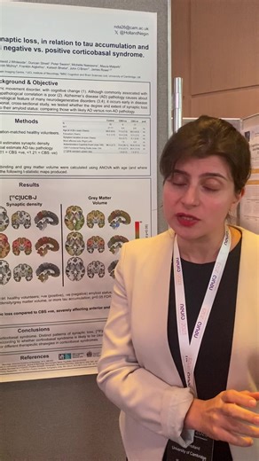 Neuro 2023: The PSP & CBD Research Symposium Update Just before lunch, we heard presentations from four poster presenters: Kurt Farrell, Ivan Martinez Valbuena, Hidetomo Tanaka and Negin Holland. Here, Negin gives an overview of her poster which displays the results from her study into CBD. #Neruo2023 #London #PSPresearch | PSPA