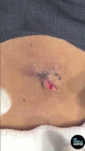 Dr. Pimple Popper vs. Inflamed Recurring Cyst