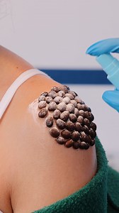 Step by step removal of skin infestation | Creative Bee