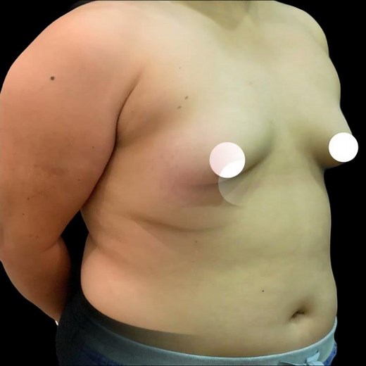 Breast Implants A Cup to D Cup Transformation #5059 · Della Bennett, MD, Rancho Cucamonga