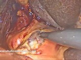 Laparoscopic Common Bile Duct Exploration and Choledochoduodenostomy • Video • MEDtube.net