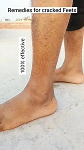 1.6K views · 4.1K reactions | Get Rid of Cracked Feet-Hand At Home ..#cracked #shorts #shortsvideo #viralvideo #ytshorts | Chanchal Sharma | Facebook