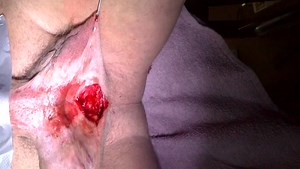 Meatotomy Subincusions Genital Modification