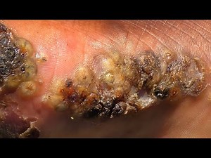 Cosmas' jigger removal - 2nd MOST JIGGERED #2 --- long videos @riseupsociety.net & @ruskenya.org