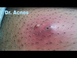 角栓 ブラックヘッド 角栓除去 ニキビ芯出し #0019