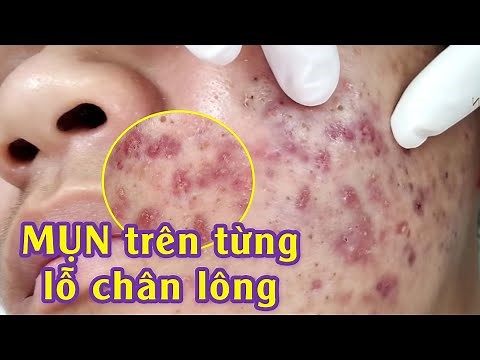 Điều trị mụn viêm, mụn bọc hiệu quả tại TPHCM | Inflammatory Acne | Minh Khôi |Hiền Vân Spa |582