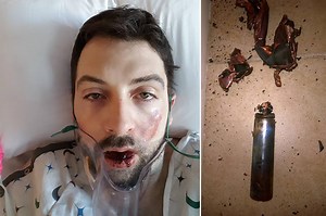 Exploding e-cig knocks 7 teeth out of man’s mouth