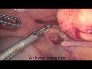 Laparoscopic Right Hemicolectomy
