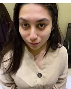 Hollywood Peel procedure! #powderroombd#hollywoodpeel#beauty | The Powder Room By Esha Rushdi.