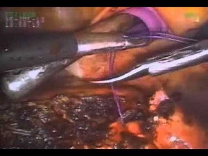Laparoscopic Liver Resection Application of Pringle Maneuver and GIA Stapling from the SAGES Video Library