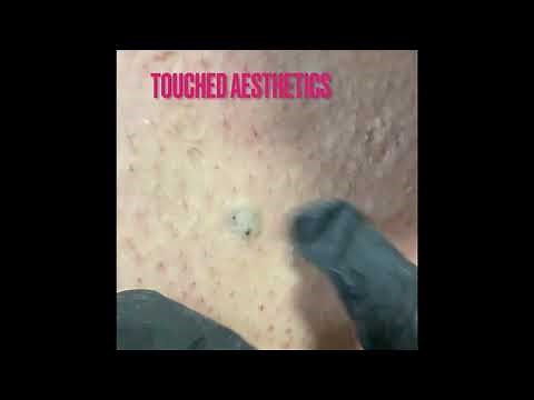 Episode 2 ingrown hair extractions