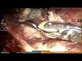Right Upper Lobectomy • Video • MEDtube.net