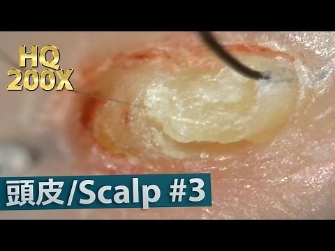 #3 Scalp Blackhead Removal Close up HQ200X