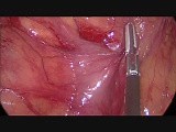Laparoscopic Fast Right Hemicolectomy • Video • MEDtube.net