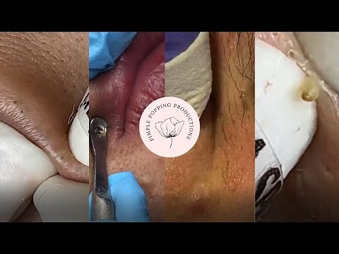 Satisfying lip blackhead extraction - part 2