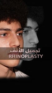 Discover the artistry of nose reshaping with Dr. Bashar Bizrah! ✨ Book your consultation today! 📅 Bizrahmed: 800249724 Noura: 0555751770 Majd: 0568328505 Roula: 0529998181 #drbasharbizrah #droopynose #bizrahmed #nosereshaping #deviatednose #rhinoplasty # blockednose #humpnose | Dr Bashar Bizrah د بشار بزرة
