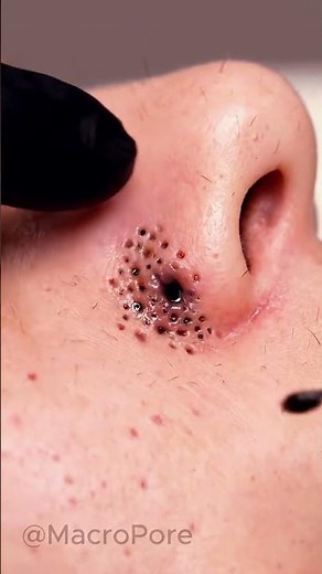 Nose Comedone Cluster Extraction | 4K Macro ASMR