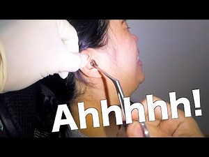 Something Plastiky Stuck In Woman's Ear Finally Removed- What Is It?