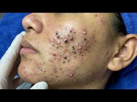 Blackhead removal with Sac Dep Spa | Satisfying and Relaxation with Sac Dep Spa #356308