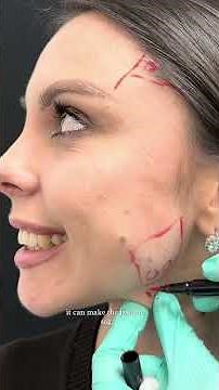 Botox for Migraines: Masseter Before & After Transformation! - DrMediSpa