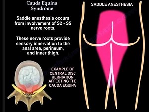 Cauda Equina Syndrome Urgent Diagnosis and Treatment