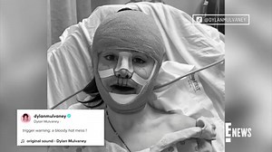 Watch TikToker Dylan Mulvaney's "Dramatic" Face Reveal Video After Surgery