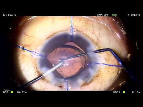 Live Cataract Surgery with Tecnis Toric IOL – Dr. Gaurav Luthra