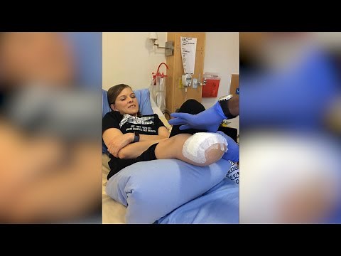 Leg Amputee Journey - April 8, 2020 - Micah Quinn