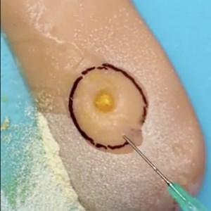 868K views · 2.4K reactions | Core Callus Treatment!  | 5-Minute Recycle | Facebook