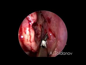 Maxillary sinus & Concha bullosa surgery. Эндоскопическая операция на верхнечелюстной пазухе