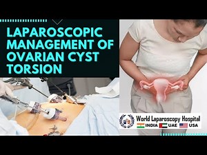 Laparoscopic Management of Ovarian Cyst Torsion
