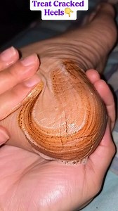 1.3M views · 6K reactions | Easy Home remedy For Cracked Heels Repair #crackedheels #heels #cracked #feetcare #reelsfypシ @top fans | Mind power | Facebook