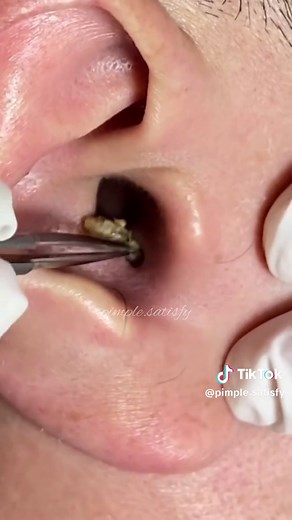 Satisfying Pimple Popping for Relaxing Sleep | Explore Compilation