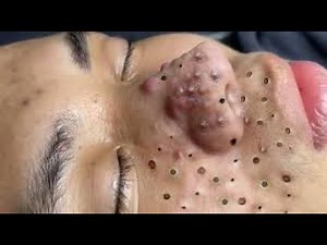 Step-By-Step Blackhead Removal on Nose