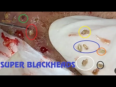 ACNE TREATMENT for Mạnh part 1 | Loan Nguyen