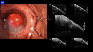 Xen Implantation Using ReScan Intraoperative OCT - Eyetube