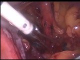 Laparoscopic Pelvic Lymph Node Dissection • Video • MEDtube.net