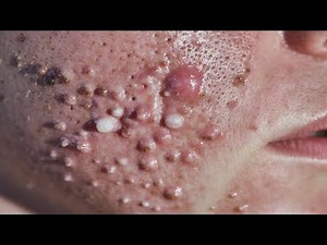Medical Extraction Procedure – Cystic & Inflamed Acne Removal