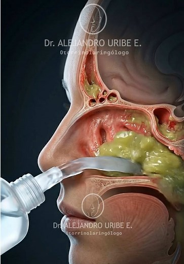 Esto es lo que hace un lavado nasal en tu nariz para aliviar la sinusitis. 💧👃 El verdadero problema de esta enfermedad no es la infección, sino el moco espeso que se queda atrapado en tus senos paranasales por la inflamación. Esa acumulación bloquea el drenaje natural y es lo que te causa esa presión insoportable en la cara. Al usar el suero, el líquido entra suavemente por tus conductos. Su trabajo es barrer y aflojar todas esas secreciones atrapadas, destapando las vías respiratorias. Cuando