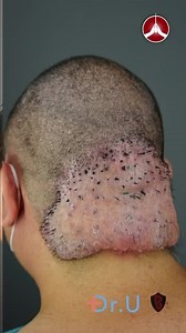 Massive Acne Keloidalis Nuchae (AKN) Removal by Dr. Umar