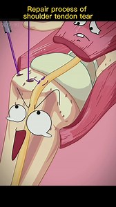 17K views · 92 reactions | #shoulder #tendon #tear #repair #foryou #fyp #sciencefacts #mathematics#physics#life #subject #science #quantumphysics, #fyp #foryou #tiktok #lnteresting#science#physics | Sience | Facebook
