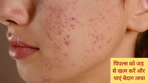 14K views · 537 reactions | Chehre ke pimples aur daag-dhabbe jad se khatam karne ka asardaar upaay | Remove Pimples | Benefits of Neem Juice | Cooking & Desi Gharelu Nuskhe | Facebook