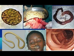 Ascaris Lumbricoides (Ascariasis) Morphology , Life cycle , Pathogesis , Treatment | Parasitology
