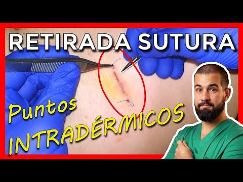 How to REMOVE CONTINUOUS SUTURE STITCHES. REAL Video Explained