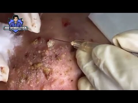 Cystic Acne Treatment / Cyst and Blackhead extraction / Pimple Popping / Clogged Pores #3